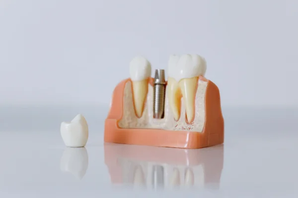 Proteza na implantach — cena (overdenture)