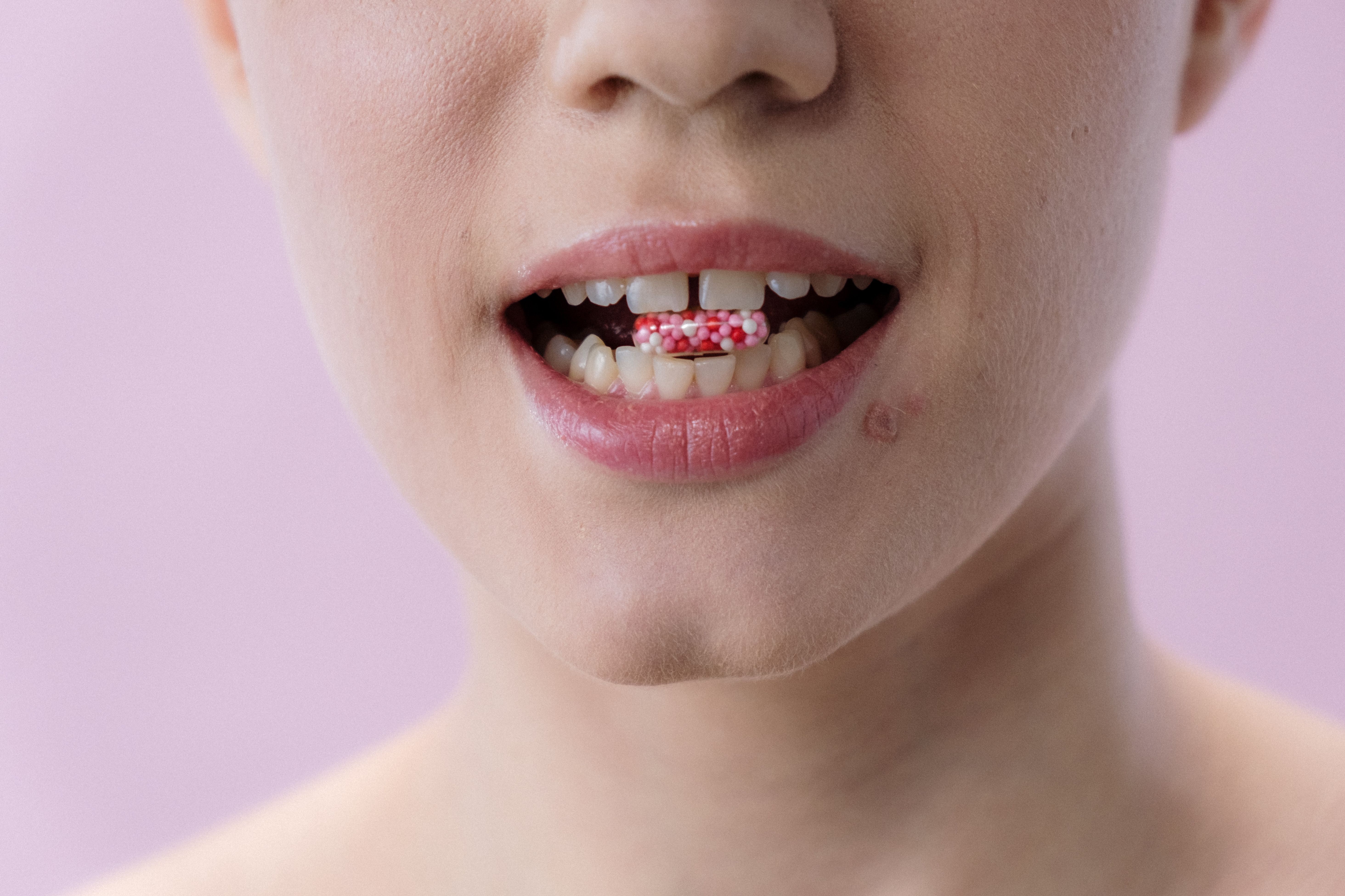 Diastema (szpara między zębami) — jak ją zamknąć