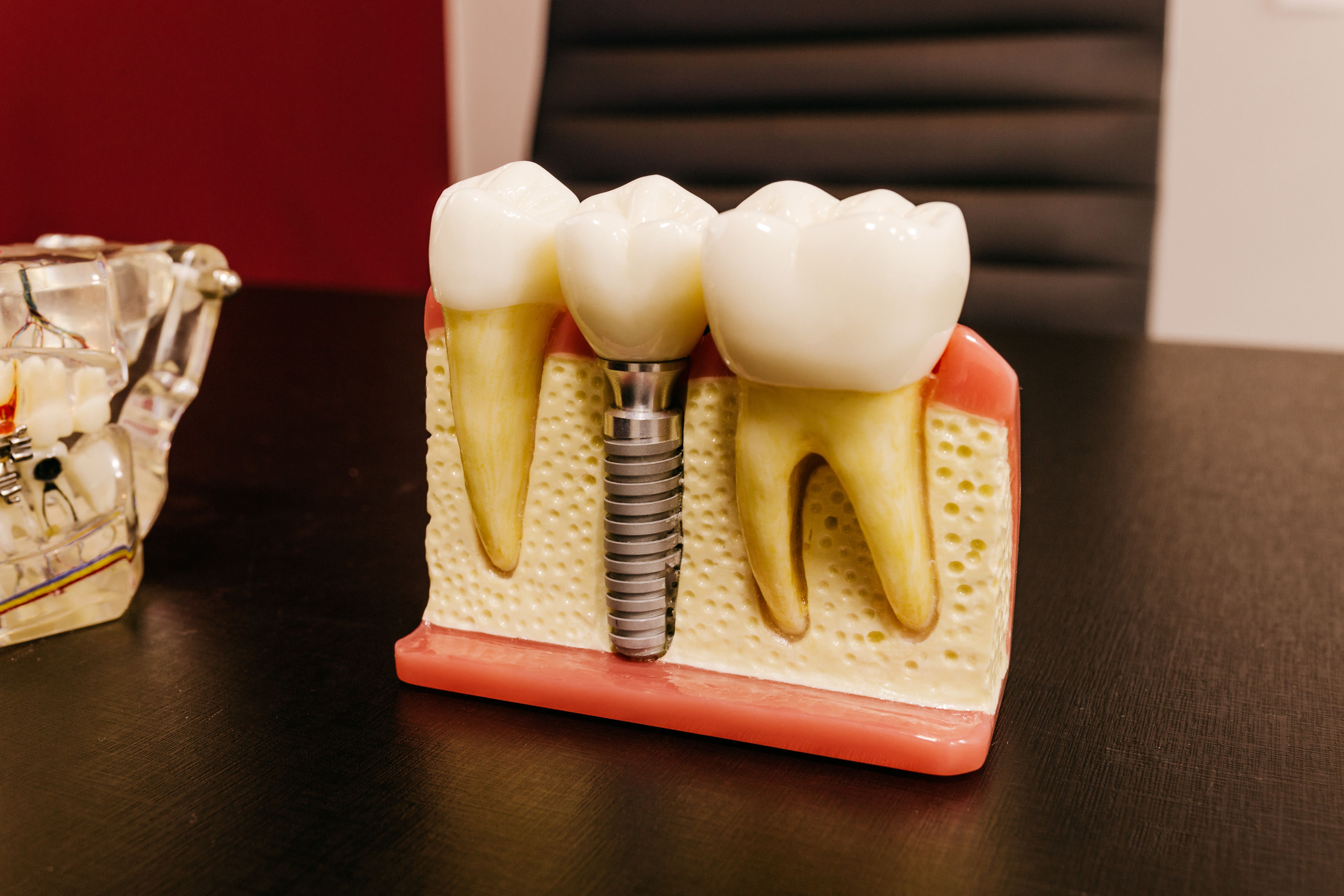 All-on-4 i All-on-6 — ile kosztuje pełny łuk na implantach